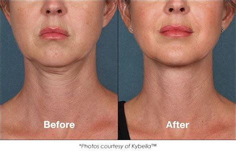 Pin By Andreea Puiu On Botox Fillers Double Chin Laser Clinics