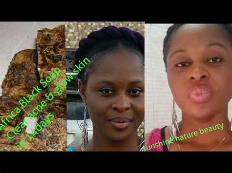 And not so long ago, cosmetologists found a way through which you can solve different. Get Rid Of Acne,Eczema/Lighten Your Skin Within 14DAYS/Get ...