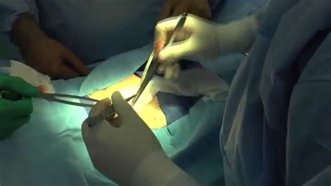 Advanced Surgical Associates Inguinal Hernia Repair Youtube