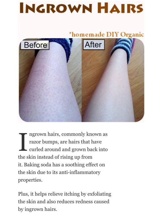 How To Exfoliate Legs With Ingrown Hairs Girounde