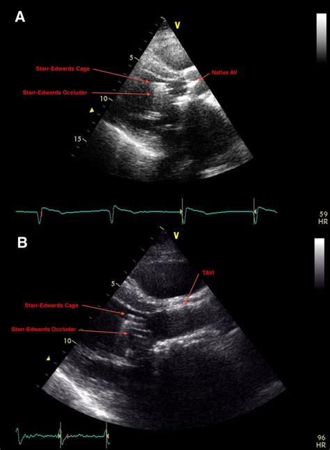 Transcatheter Aortic Valve Implantation In A Patient With Previous