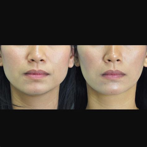 How Long Does Masseter Botox Last