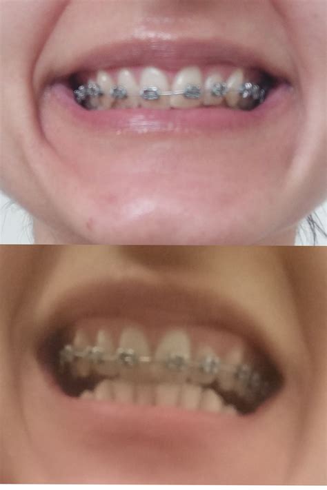 1st week with braces bottom braces going on in 6 wks i have a really deep bite and crossbite