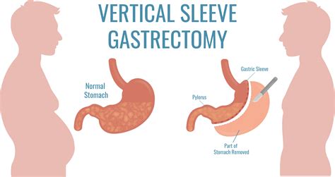 Gastric Bypass Vs Gastric Sleeve Compare Procedures 2022