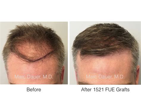 Fue Hair Transplant Optimizing Your Donor And Making Every Graft Count