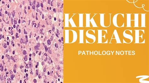 Kikuchi Diseasesubacute Or Histiocytic Necrotizing Lymphadenitis