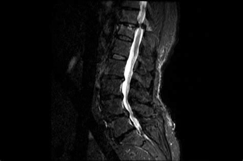Case Report: Chronic Back Pain, Lower Extremity Weakness ...