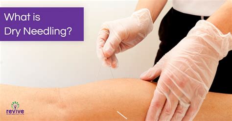 what is dry needling revive physio therapy and pilates