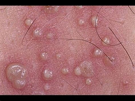View a picture of herpes simplex virus type 2 and learn facts about sexually transmitted diseases. Herpes Type 1 | Herpes Type 2 - YouTube