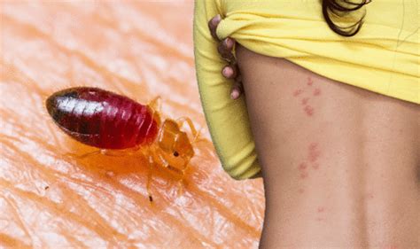 You can try home remedies that relief. Bed bug bites: What does a bed bug bite look like? Five ...