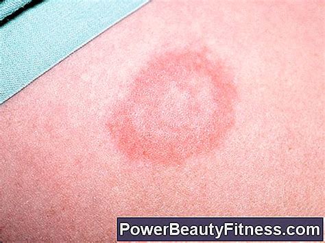 Circular Skin Rashes Usually Misdiagnosed In Children 💪 All About