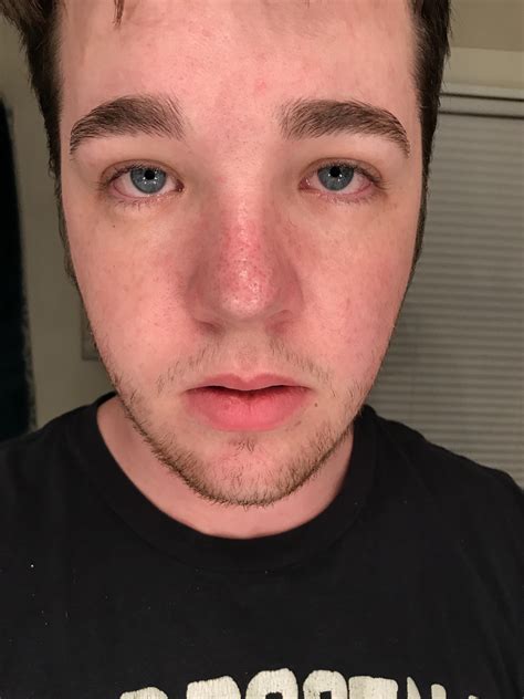 Skin Concern Please Help This Redness Has Been On My Nose For Years