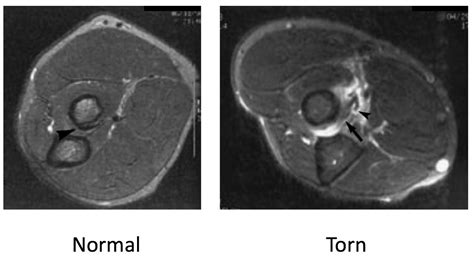 Elbow Muscle Anatomy Mri