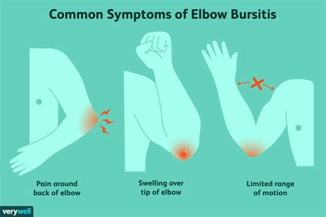 Elbow Olecranon Bursitis Signs And Treatments
