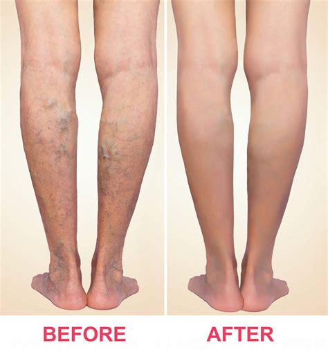 Sclerotherapy Procedure Recovery Aftercare Side Effects