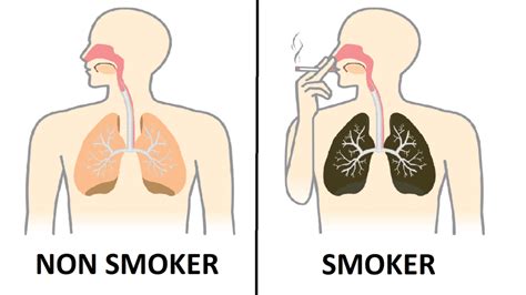 Nurse Explains What Smoking Every Day Does To Your Lungs