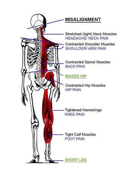 Knee Chest Chiropractic Cape Girardeau Upper Cervical Care