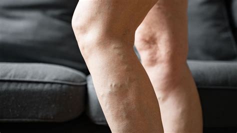 Treat Restless Legs Syndrome With 4 Effective Varicose Vein Treatments Ithriveveins