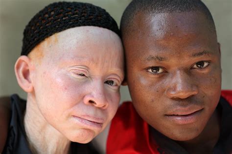 Albinism In Cameroon