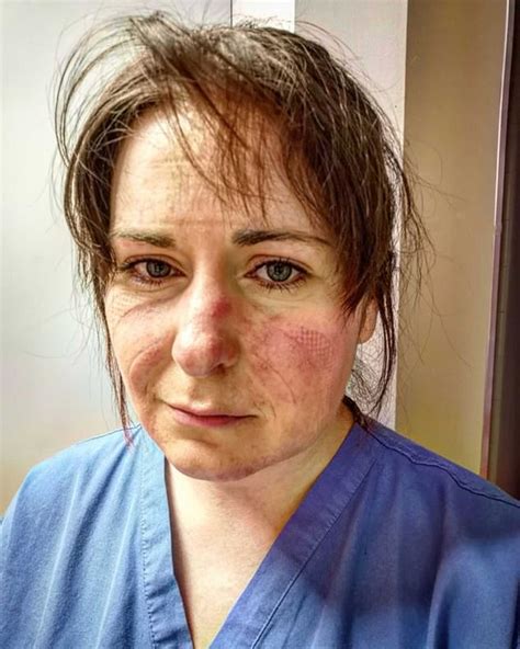 Intensive Care Nurse Posts Picture Of Her Exhausted Face Bruised By