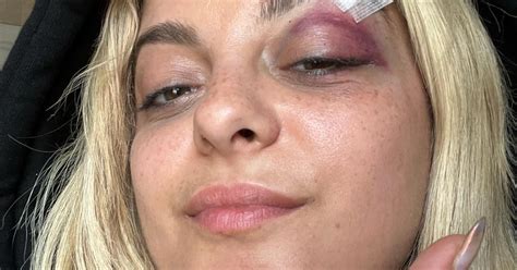 bebe rexha shares black eye pics after fan throws phone at her