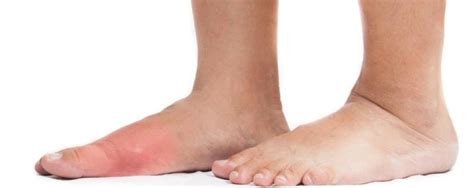 Bump On Top Of Foot Causes And Treatments Bino Massage