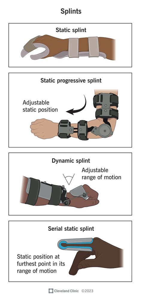 Splint Types Uses And How Long To Wear Them