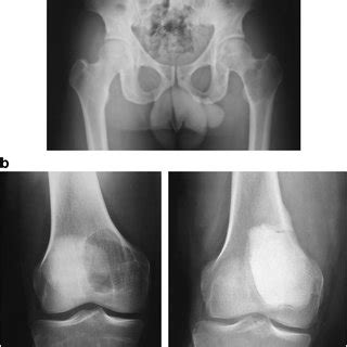 Typical Radiographic Appearance Of Giant Cell Tumor Of Bone Cgtb With