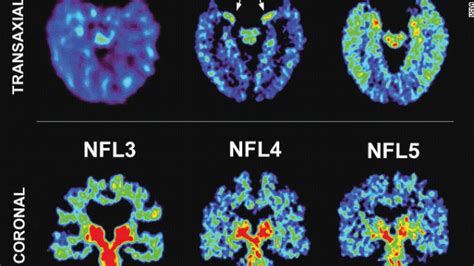 As researchers learn more about the disease, it's becoming clear that the scope of people affected goes beyond wealthy former nfl players and extends to those who play less lucrative. Scan may detect signs of NFL players' brain disease - CNN.com