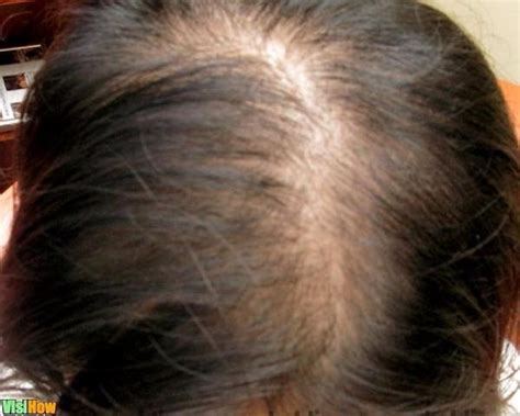 According to the american hair loss association. Use Homeopathic Remedies to Treat Hair Loss Due to Anemia ...