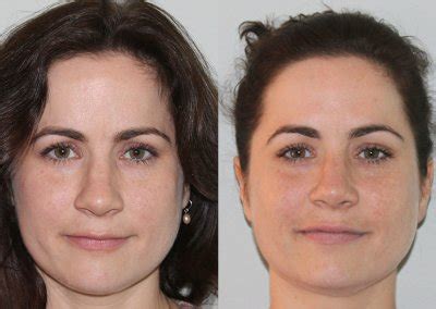 Learn about nasal polyp surgery with dr. Before and After Nasal Surgery Photos - Dr Garrett Bennett ...