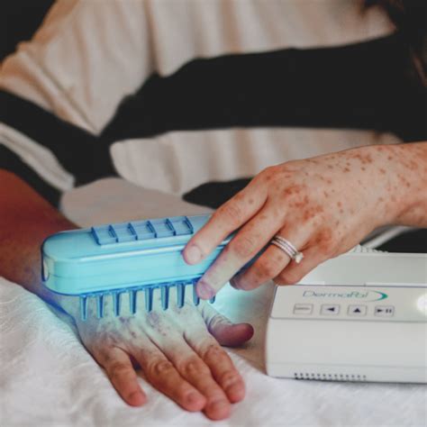 5 Things to Know About Home Phototherapy for Vitiligo  Living Dappled