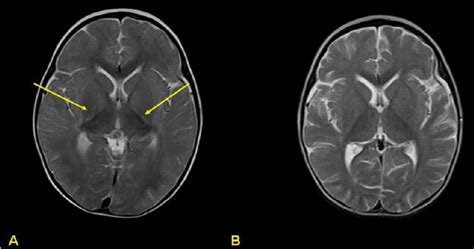 T2 Weighted Axial Magnetic Resonance Image Mri Image Shows Increased
