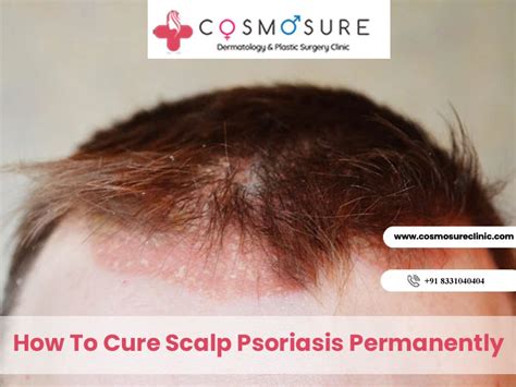 How To Cure Scalp Psoriasis Permanently Cosmosure Clinic