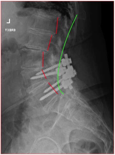 Failed Back Surgery Syndrome The Spinal Centre