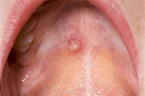 During the first phase that lasts about 3 days, the skin breaks out in red bumps. Chicken pox lesion in mouth - Stock Image - M130/0899 ...
