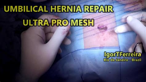 Umbilical Hernia Repair With Mesh Gopro 1080p Youtube