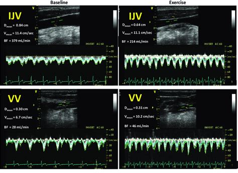 Doppler Ultrasound Images Showing The Internal Jugular Vein Ijv Upper