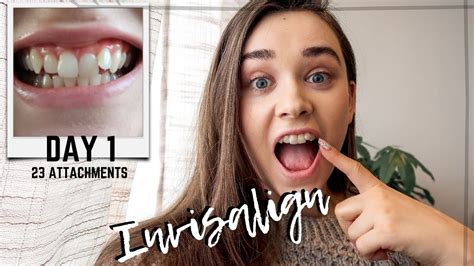 Invisalign Journey The First Day Of Wearing Invisalign Pain Lisp