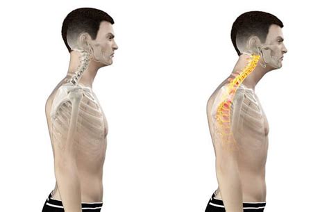 How To Stretch Levator Scapulae For Neck Pain Easy Way Ease Your Pain