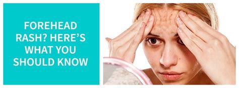 Forehead Rash Here S What You Should Know Forehead Rashes Health