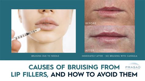 Causes Of Bruising And Swelling From Lip Filler Treatment And How They