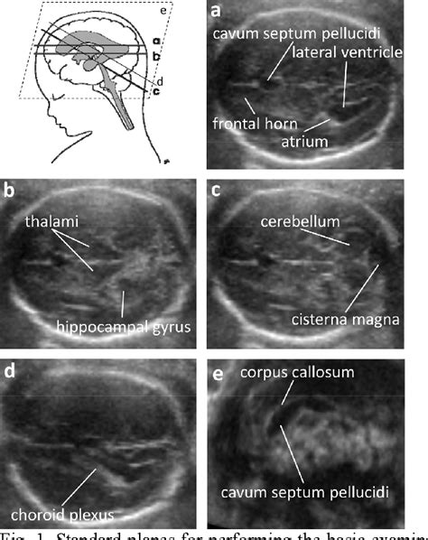Figure 2 From Automatic Measurement Of Fetal Head Structures Using