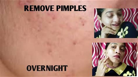How To Remove Pimples Pimple Acne Pimple Marks 100 Effective