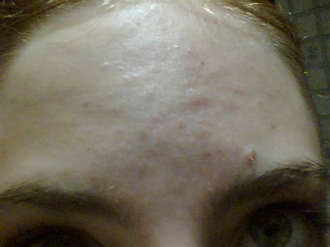 Bumps On Forehead After Sun Exposure General Acne Discussion Acne Org