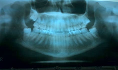 Apply an ice pack for swelling and pain. x-ray of my impacted wisdom teeth | Dental hygenist ...