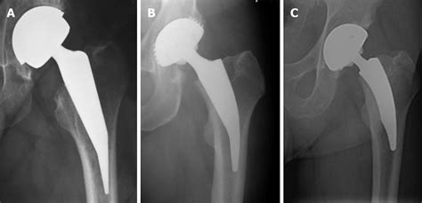 Calcar Guided Short Stem Total Hip Arthroplasty Will It Be The Future