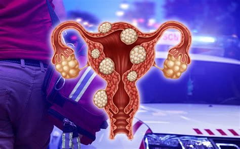 Fibroid rahim adalah jenis tumor jinak pada rahim yang bisa membuat wanita jadi sulit hamil. Kaitan Di Antara pil perancang dan ketumbuhan (cyst) serta ...