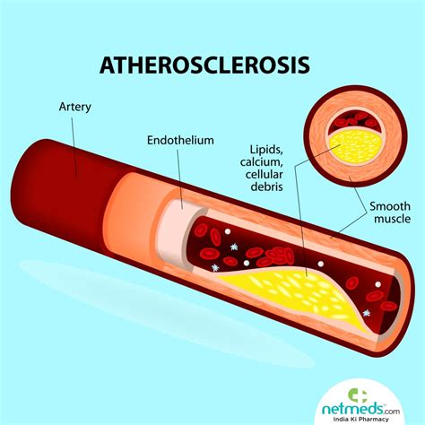 Describe The Changes In Arteries That Occur With Atherosclerosis