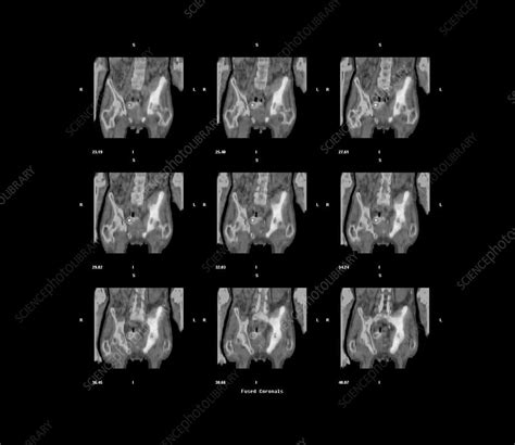 Bone Cancer Ct Scans Stock Image C0148084 Science Photo Library